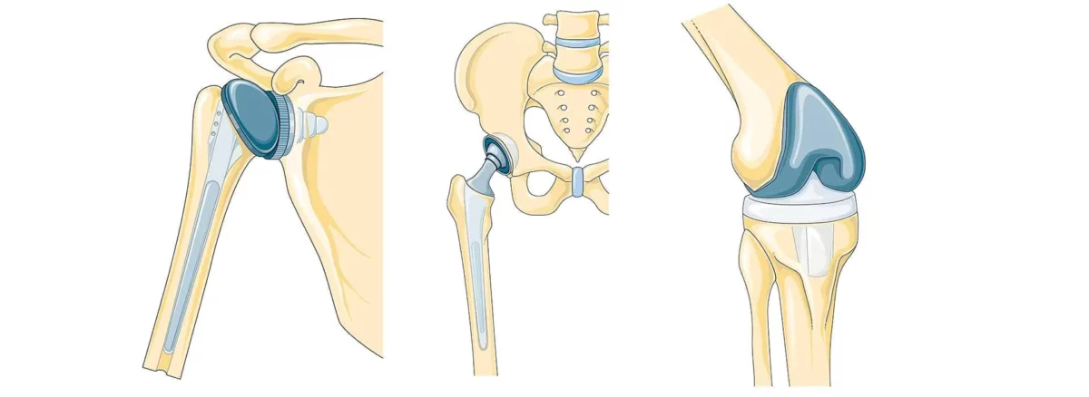 Ендопротезування (заміна суглобів) Київ: ціни 2025